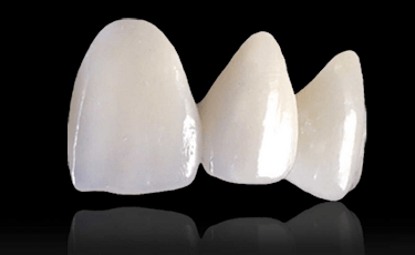 審美歯科の種類